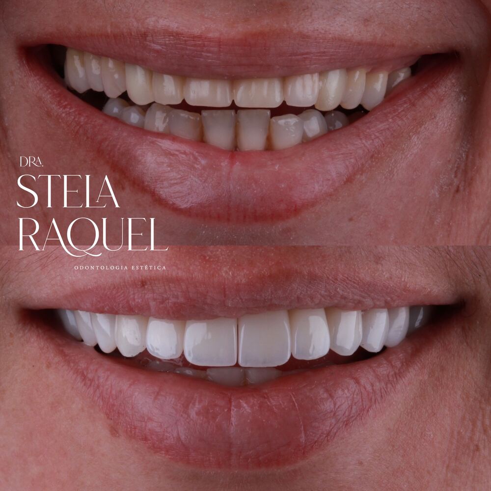 Antes e depois - Reabilitação estética