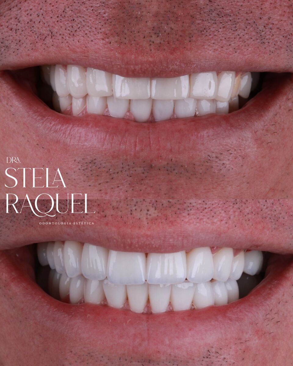 Antes e depois - Implante dentário