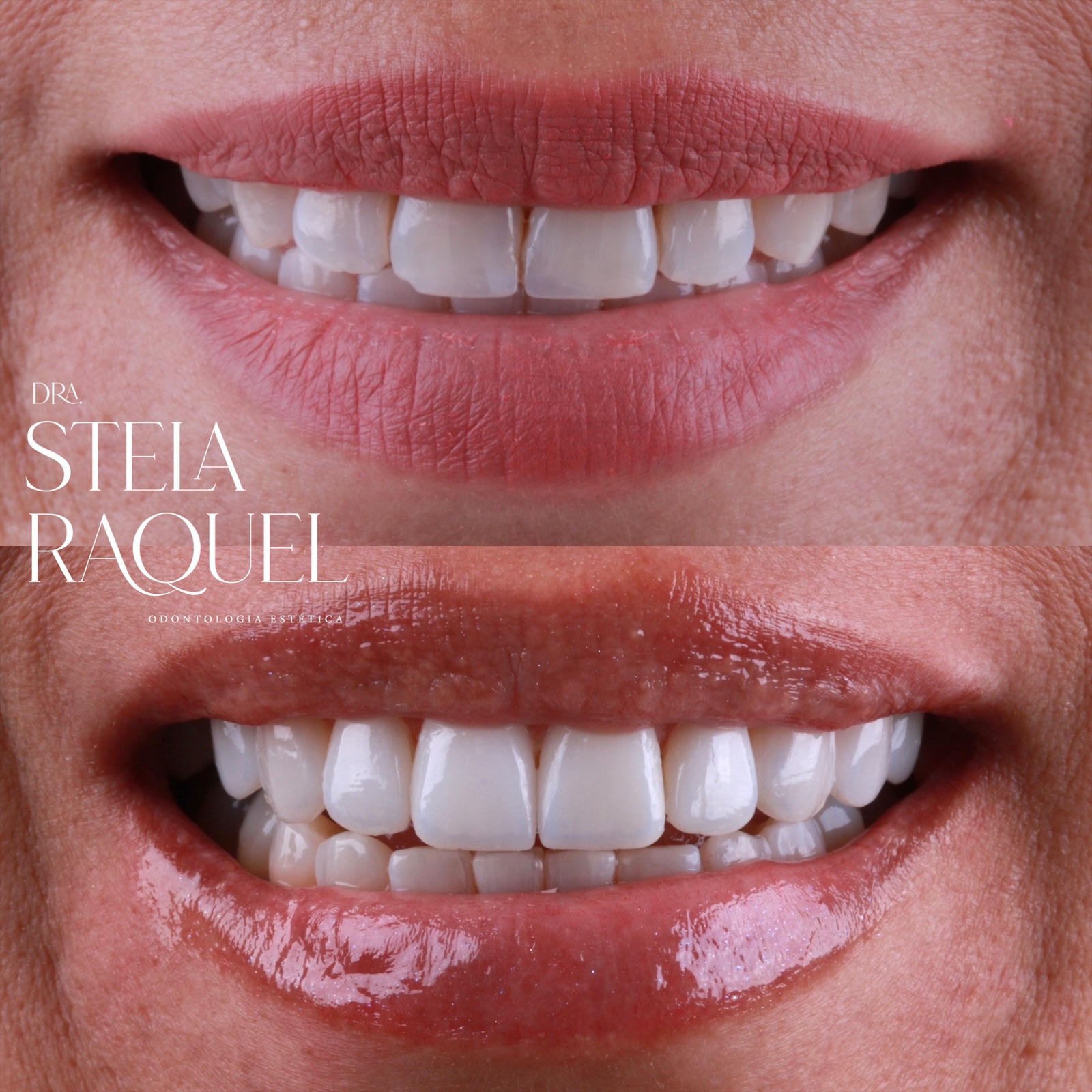 Antes e depois - Reabilitação estética