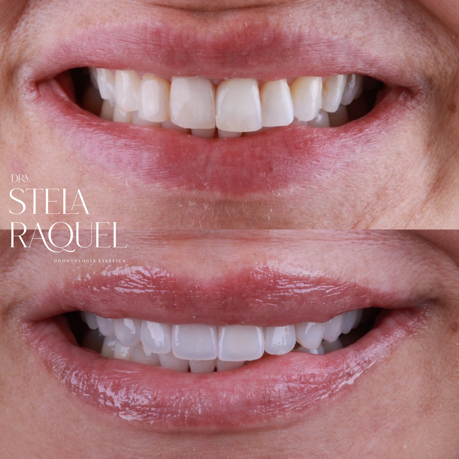 Antes e depois - Harmonização do sorriso
