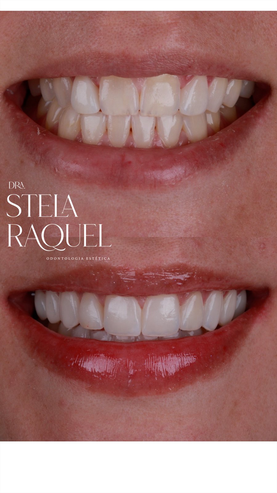 Antes e depois - Reabilitação estética