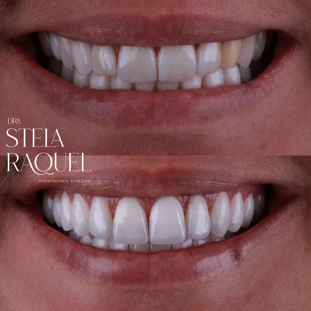 Antes e depois - Harmonização do sorriso