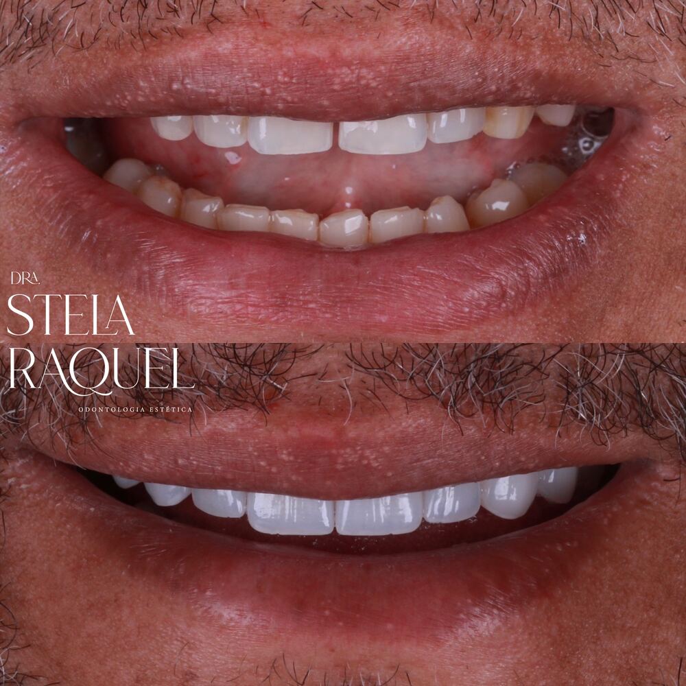 Antes e depois - Reabilitação oral