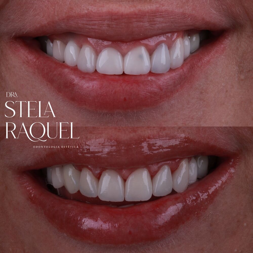 Antes e depois - Sorriso renovado