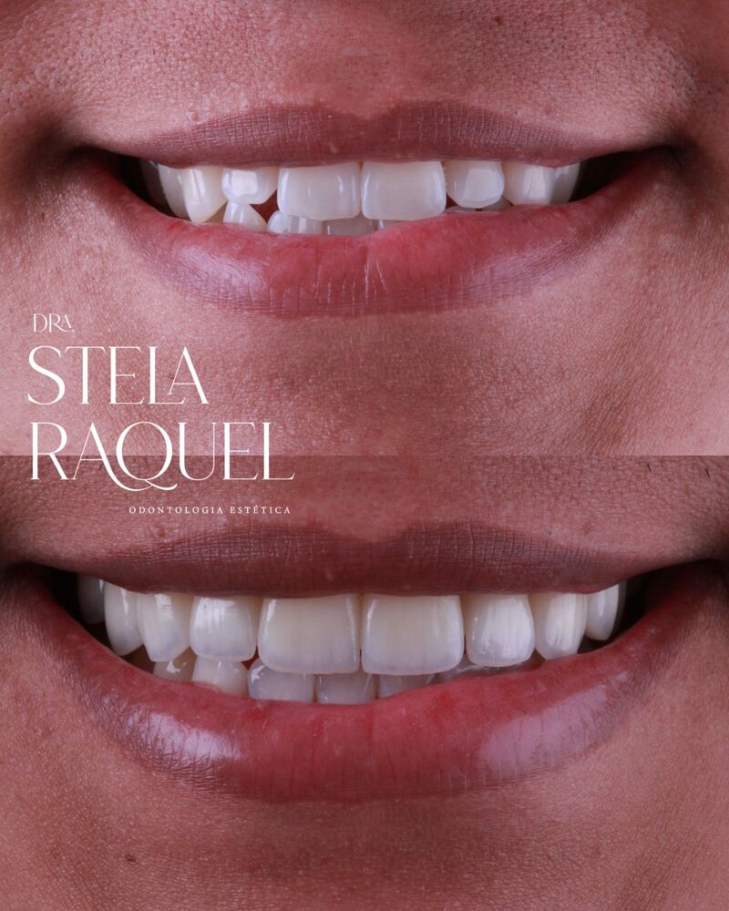 Antes e depois - Estética dental
