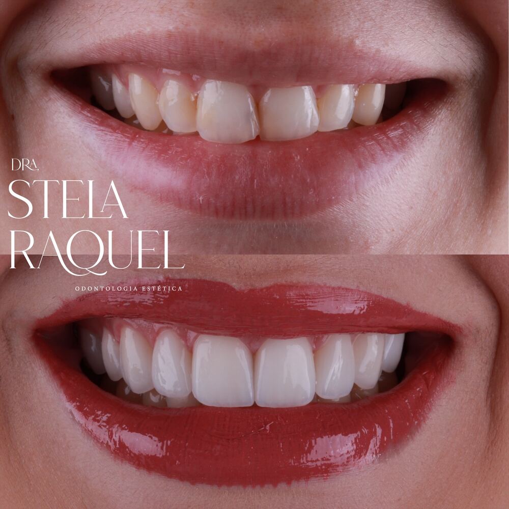 Antes e depois - Caso especial